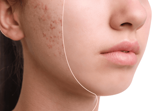 SK&S farming's spirulina soap for acne treatment 